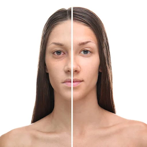 tratamiento de ojeras